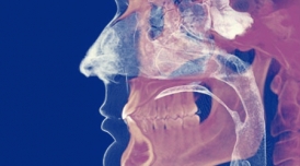 การใช้ Dental CT Scan ร่วมกับการวางแผนก่อนการรักษา ช่วยเพิ่มความสำเร็จในการทำรากเทียมและความปลอดภัยแก่คนไข้