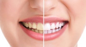 คำแนะนำหลังการฟอกสีฟัน