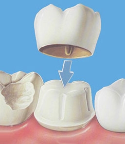 ทันตกรรมประดิษฐ์ (ใส่ฟัน)