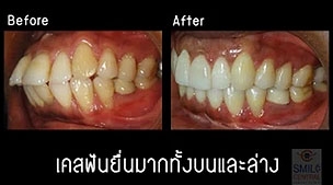 จัดฟัน invisalign เคสฟันยื่นมาก