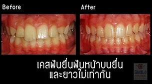 จัดฟัน invisalign เคสฟันยื่น ฟันหน้ายาวไม่เท่ากัน