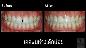 จัดฟัน invisalign เคสฟันห่าง