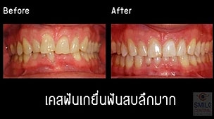 จัดฟัน invisalign เคสฟันสบลึก